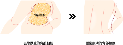 去除厚重的背部脂肪  ➤  塑造順滑的背部線條