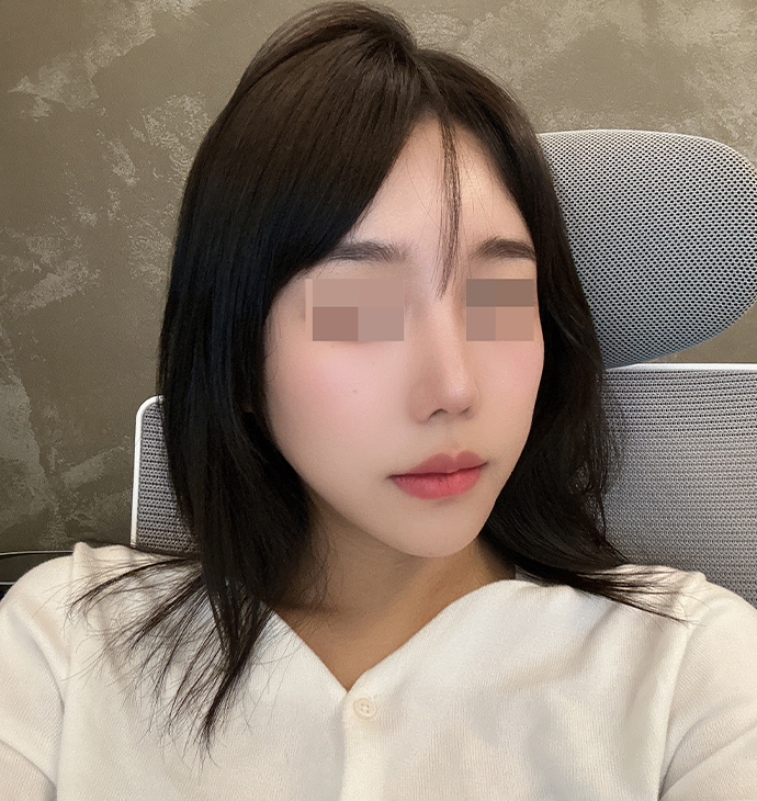 BBAE吸脂醫院 面部脂肪移植