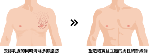 [去除乳腺的同時清除多餘脂肪] >> [塑造結實且立體的男性胸部線條]