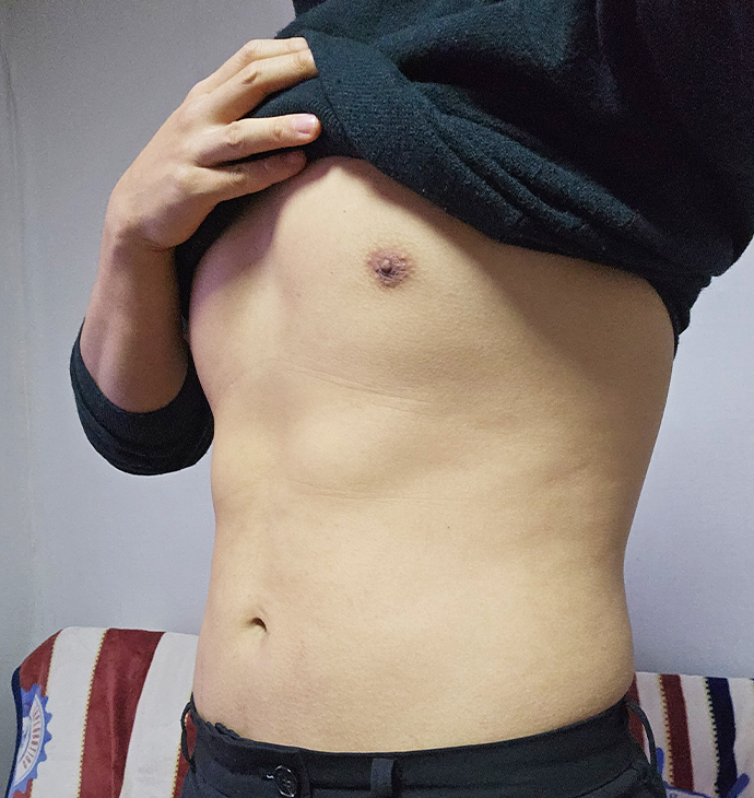 BBAE吸脂醫院 男性女乳症
