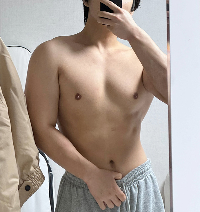 BBAE吸脂醫院 腹部吸脂